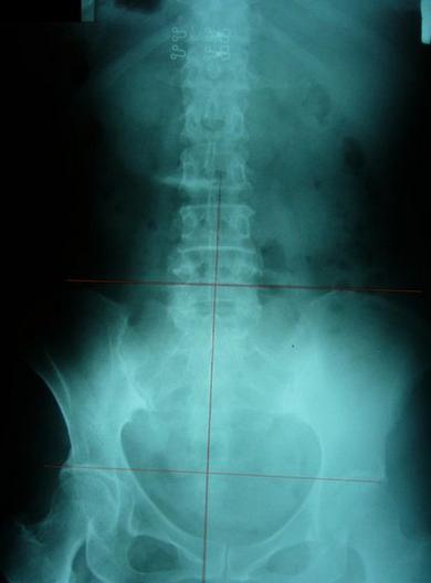 屁股歪了是怎么回事,屁股歪了骨盆怎么矫正