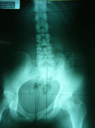 屁股歪了是怎么回事,屁股歪了骨盆怎么矫正