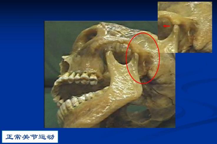 颞颌骨张口闭口咯咯响怎么办,下颌关节综合征张口闭口有弹响