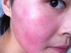 戴口罩脸过敏发红痒怎么办,脸过敏发红痒用肤专家可以吗