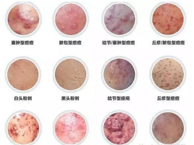 脸上起死皮还痒长疙瘩怎么回事,脸上长红疮起皮