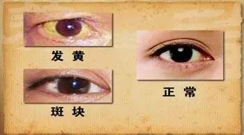 爱眼日|眼睛不适提醒你的11种病！