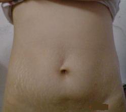 生完孩子的六大后遗症苦不堪言,生育后需要做什么修复