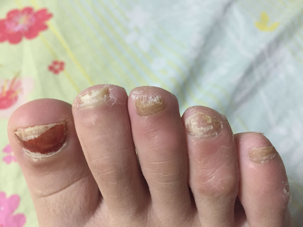 灰指甲是皮肤病，难治！你可以试试这个方法！