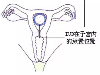 什么样的女性不适合上环,单身女性上环是什么心态