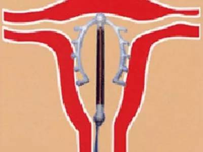 什么样的女性不适合上环,单身女性上环是什么心态