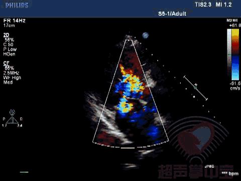 经典病例▏二尖瓣囊肿中竟然全是血液？