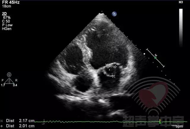 经典病例▏二尖瓣囊肿中竟然全是血液？