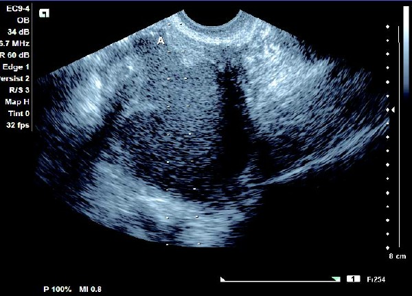卵巢巧克力囊肿彩超描述,卵巢巧克力囊肿的超声诊断要点