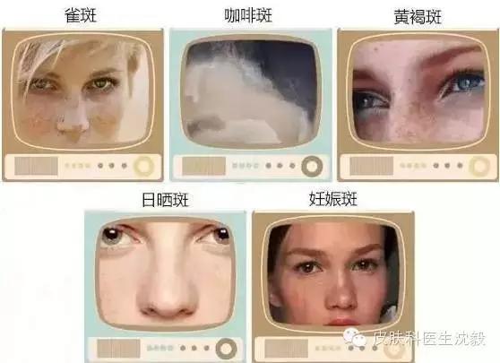 激光祛斑不忌口可以吗,激光祛斑不打麻药