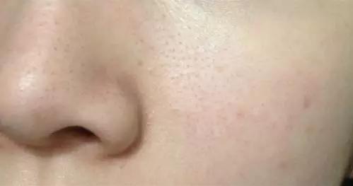 痘痘科普视频,痘痘知识科普祛痘印