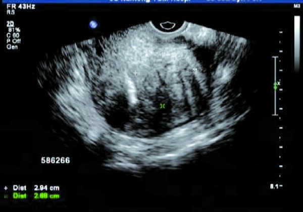 关于子宫内膜异位的病例,子宫内膜异位症者的症状