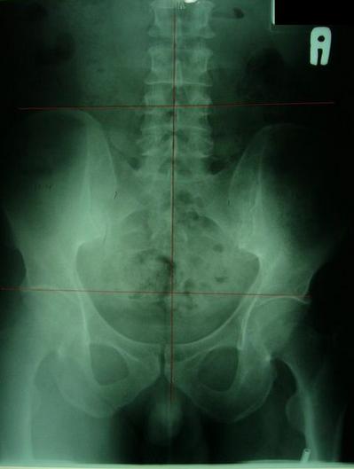 屁股歪了是怎么回事,屁股歪了骨盆怎么矫正