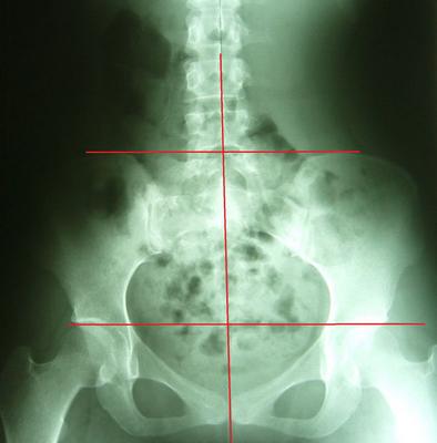 屁股歪了是怎么回事,屁股歪了骨盆怎么矫正