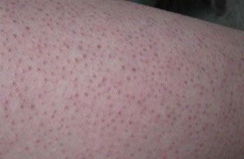 你是哪种类型的鸡皮肤,根治鸡皮肤最好的方法