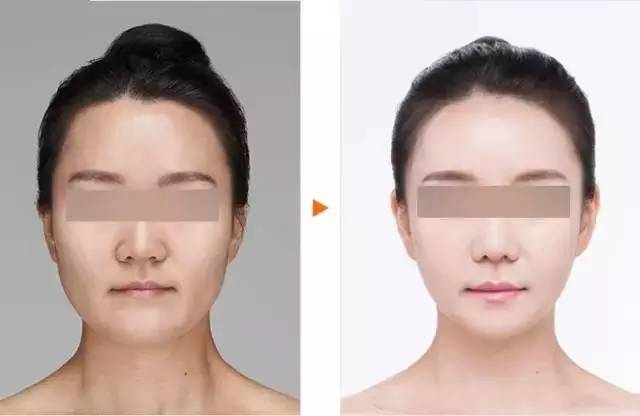 技术贴的正确贴法视频,技术贴如何快速撤下来