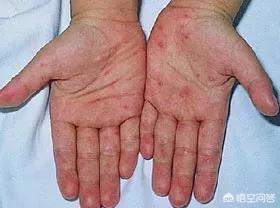 肝脏代谢慢有什么症状,喝酒肝脏受损有什么症状和表现