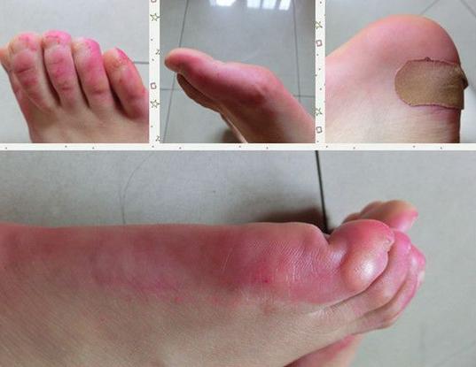 女士皮鞋后跟打脚怎么处理,皮鞋打脚有什么方法解决