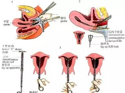 什么样的女性不适合上环,单身女性上环是什么心态