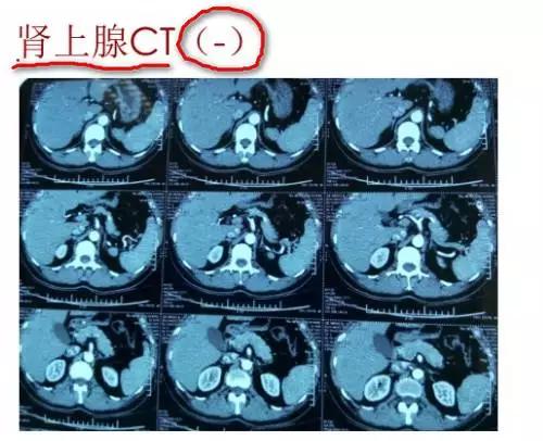 28岁出现高血压，恐怕没这么简单！