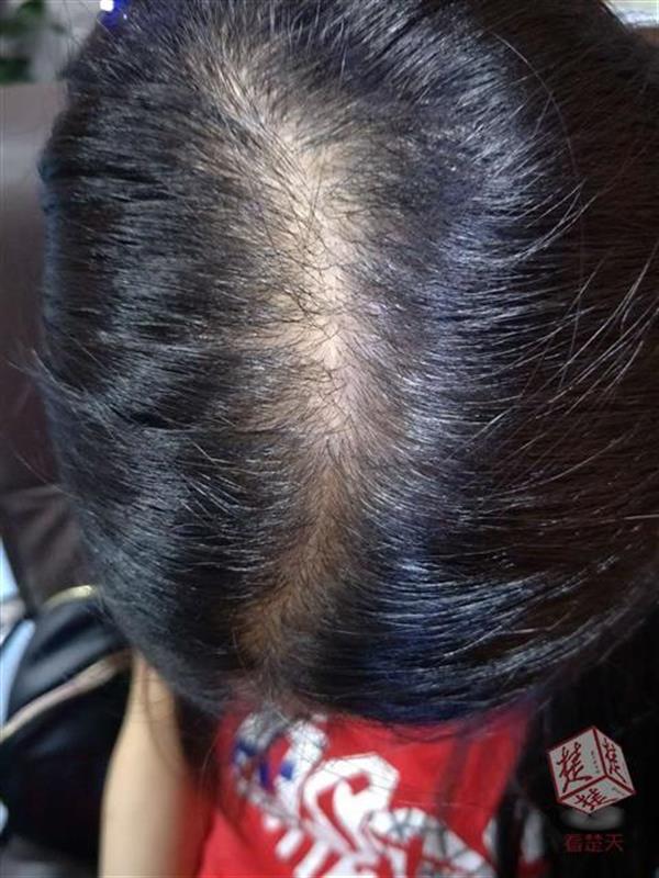 女子整形返还费用,女子花数万元植发