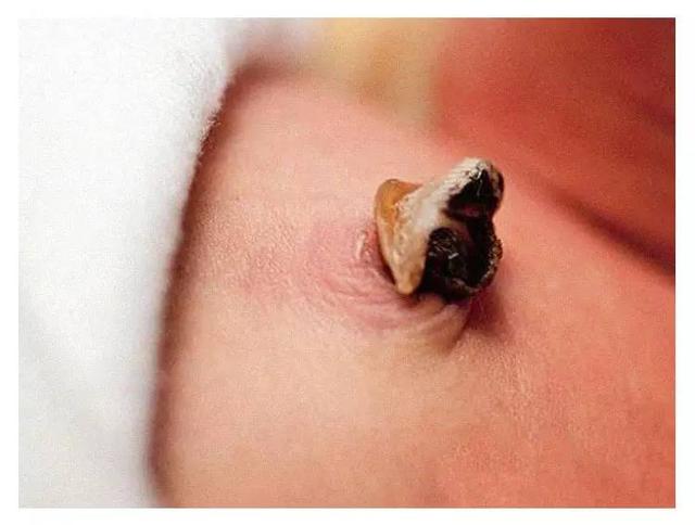 宝宝肚脐处理视频,宝宝肚脐炎症怎么治疗