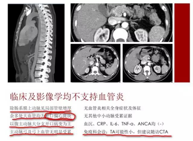 28岁出现高血压，恐怕没这么简单！