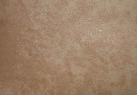 治汗斑有什么土方法,汗斑可以彻底治好吗