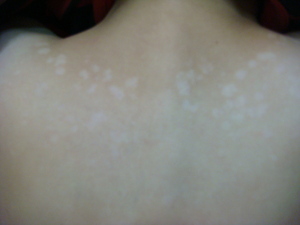 治汗斑有什么土方法,汗斑可以彻底治好吗