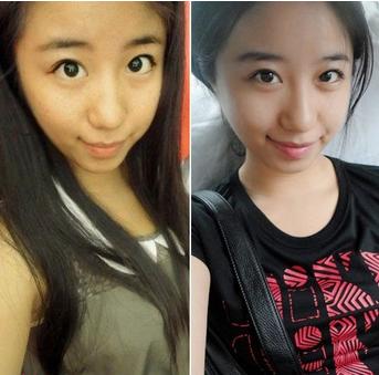 眼角长黄褐斑怎么治疗,十岁女孩眼角长雀斑是怎么回事