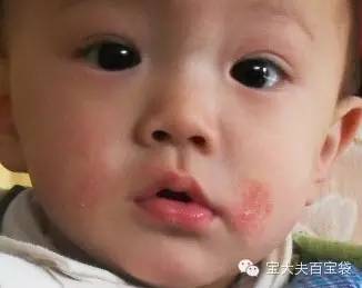 湿疹好了妈妈还需忌口,湿疹来了怎么办