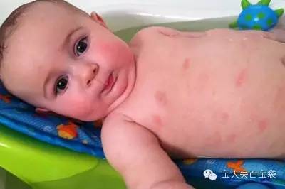 湿疹好了妈妈还需忌口,湿疹来了怎么办