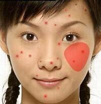 痘痘是身体什么地方出了问题,痘痘告诉你哪里生病了