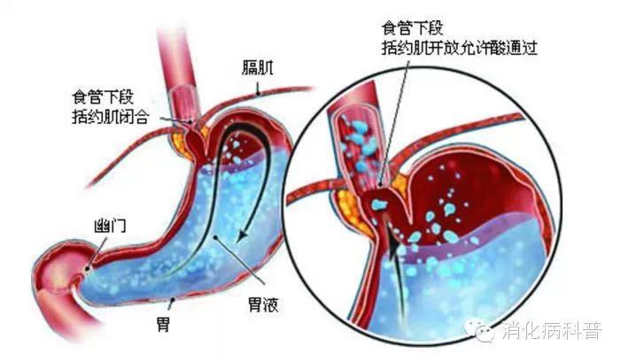 胃胀反酸烧心吃什么药,反酸烧心是怎么一回事如何治疗