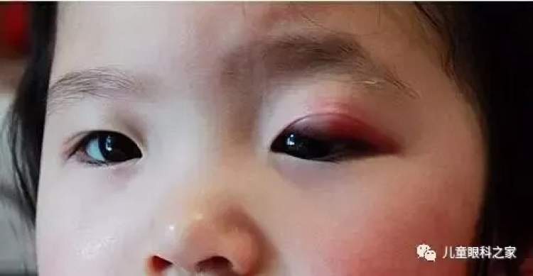 小孩眼红流泪有眼屎用什么滴眼液,孩子眼红有眼屎眼睛痒怎么办