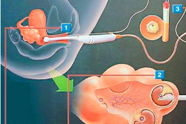 女大学生卖卵20颗赚3.5万最后住院这是违法买卖