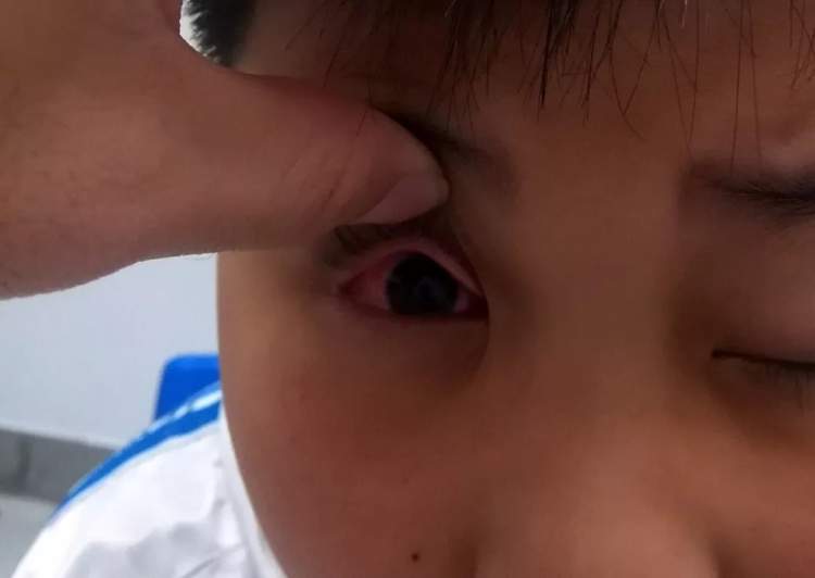 小孩眼红流泪有眼屎用什么滴眼液,孩子眼红有眼屎眼睛痒怎么办