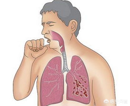 支气管扩张能彻底治好么,支气管扩张能彻底治好吗