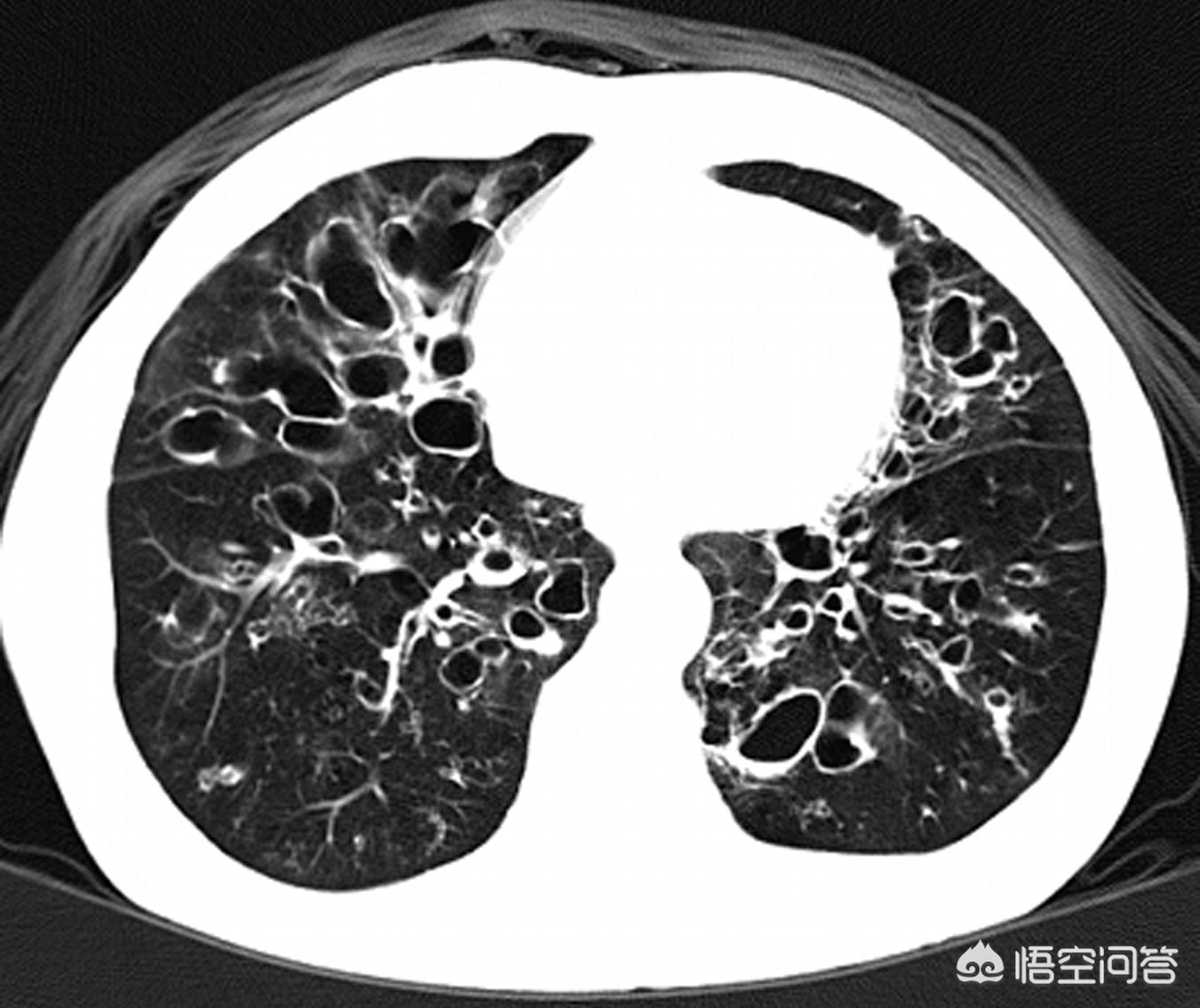 支气管扩张能彻底治好么,支气管扩张能彻底治好吗