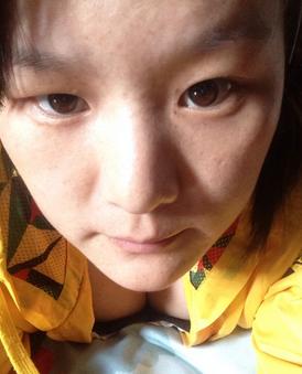 眼角长黄褐斑怎么治疗,十岁女孩眼角长雀斑是怎么回事