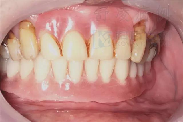 活动假牙戴不住，种植牙又嫌贵该怎么办？