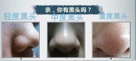 白头粉刺和炎症丘疹的区别,粉刺结节的最佳治疗方法