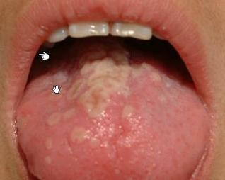 怎么预防孩子嗓子有疱疹小妙招,怎么预防小朋友嘴角疱疹