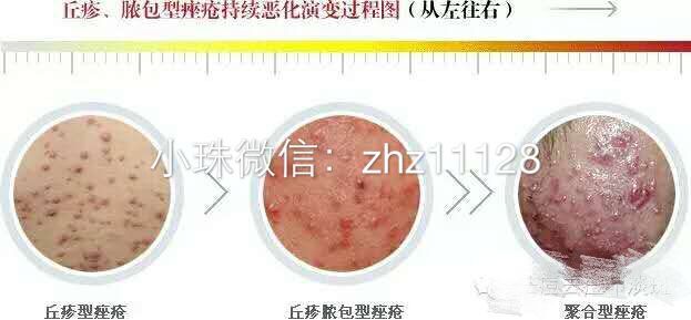 白头粉刺和炎症丘疹的区别,粉刺结节的最佳治疗方法