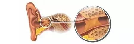 耳屎是稀的真的是狐臭吗,稀耳屎有狐臭怎么调理