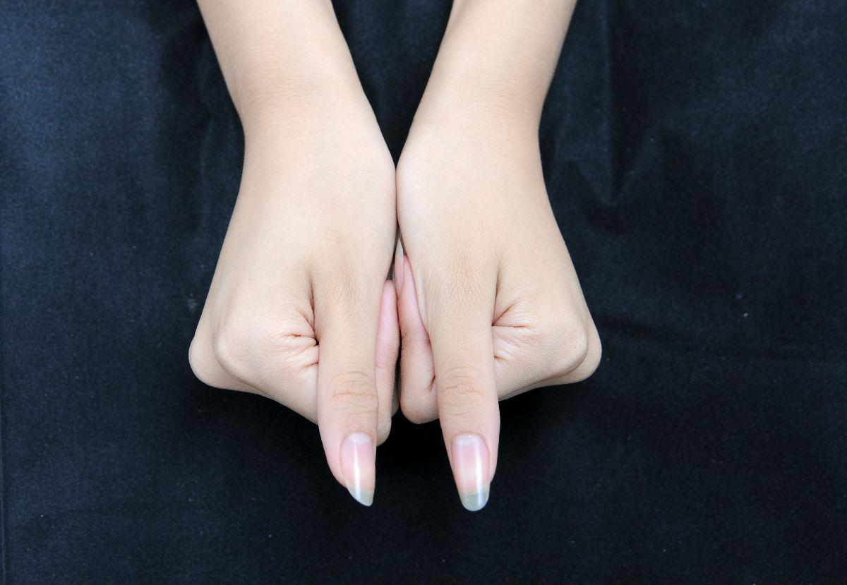 治疗鹅掌风手癣妙方,手癣鹅掌风用什么药能彻底根除