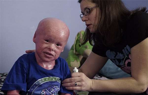 小儿子鱼鳞皮肤,小男孩出生就患皮肤病