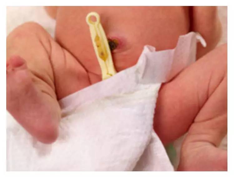 宝宝肚脐处理视频,宝宝肚脐炎症怎么治疗