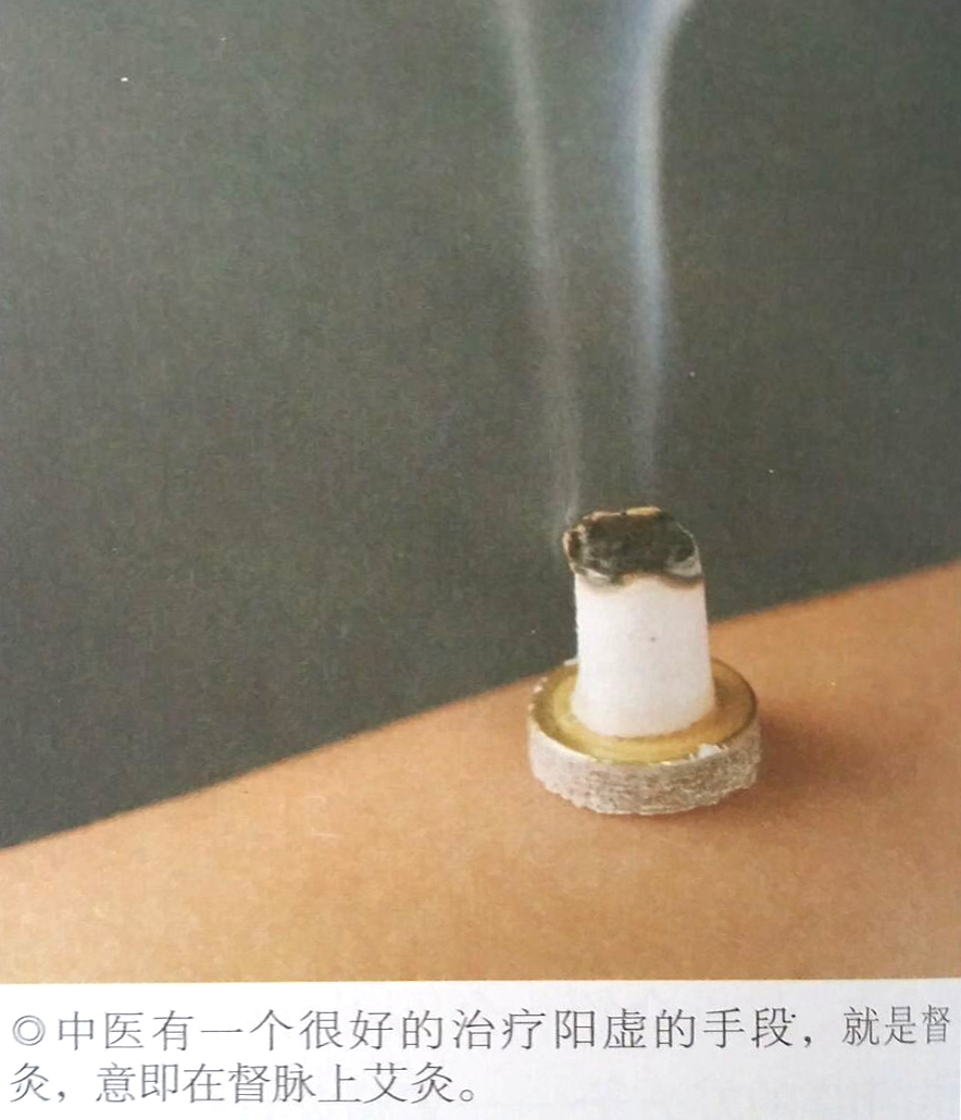 灸督脉，治疗阳虚不用吃药