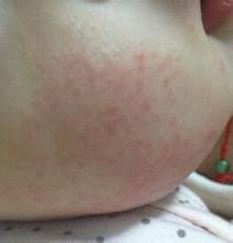 湿疹老是反反复复怎么治疗,湿疹反反复复的该怎么治疗